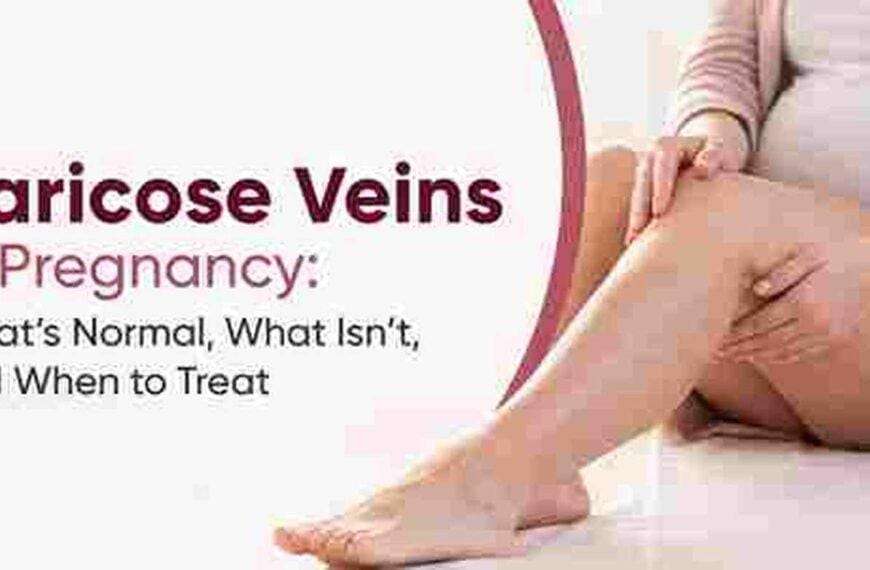 Varicose Veins In Pregnancy: What’s Normal, What Isn’t, And&hellip;